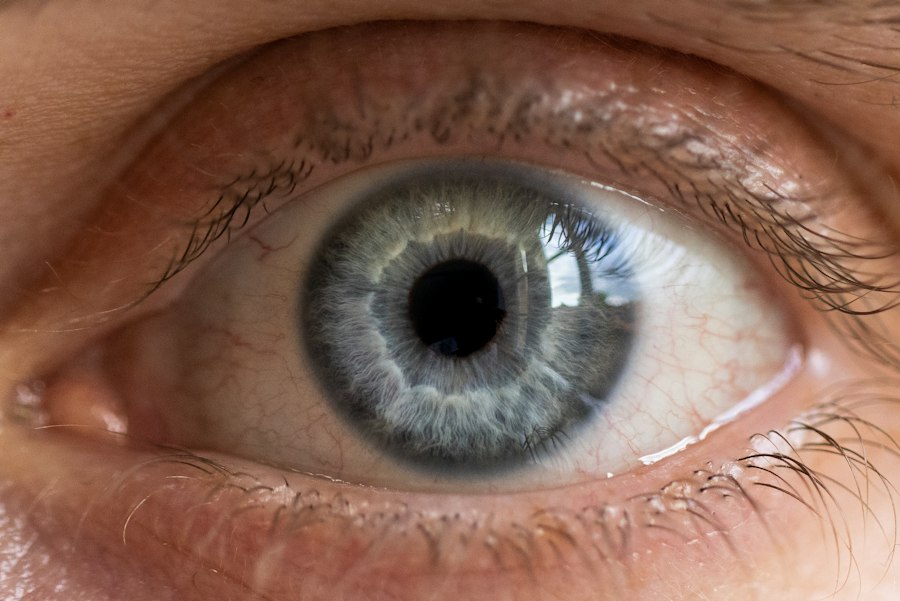 Photo astigmatism progression eye condition