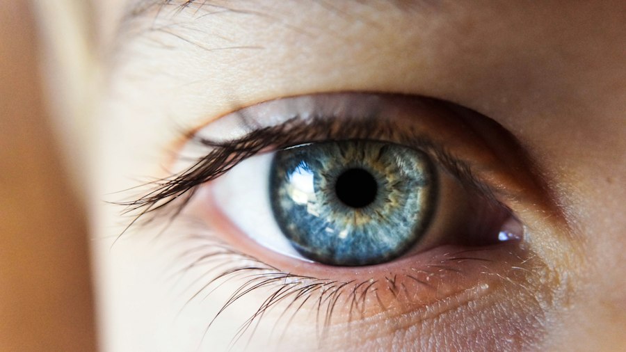 Photo astigmatism progression eye condition